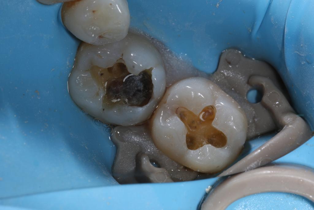 Posterior Composite Course